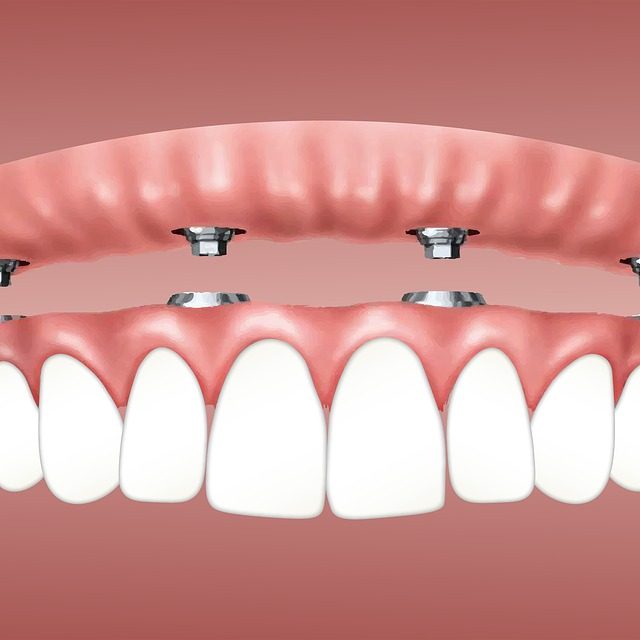 implantes