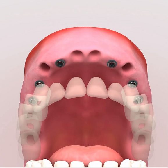 implantes2