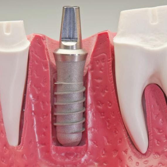 implantes3