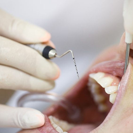 periodoncia2 43278139 - periodontal probe, held by dental hygienist, measuring pocket depths around tooth, examining progression of periodontal disease. dental hygiene, periodontal disease and prevention concept.