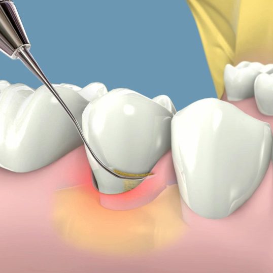 periodoncia4 periodoncia4