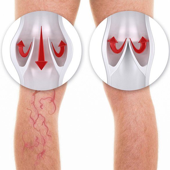 varices4